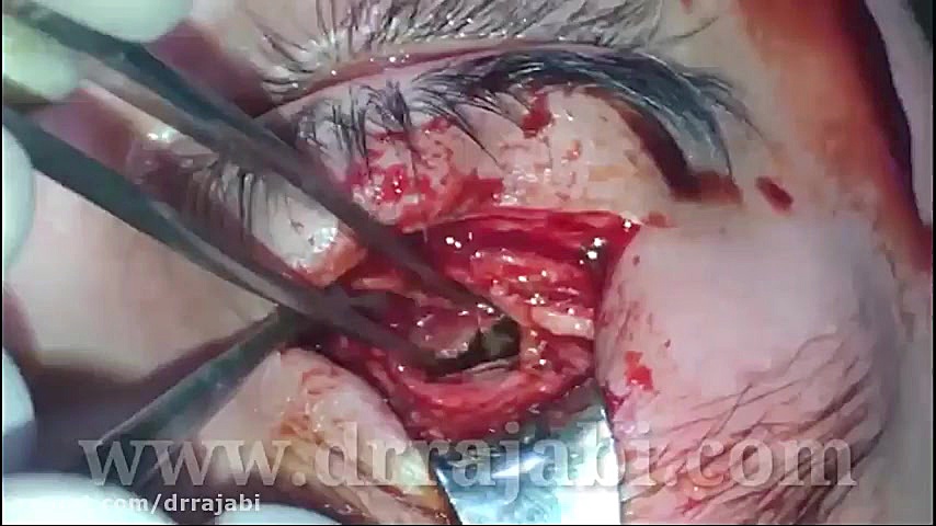 جراحی هماتوم سقف کاسه چشم در کودکان استفان کری