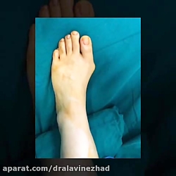 عمل هالوكس والگوس