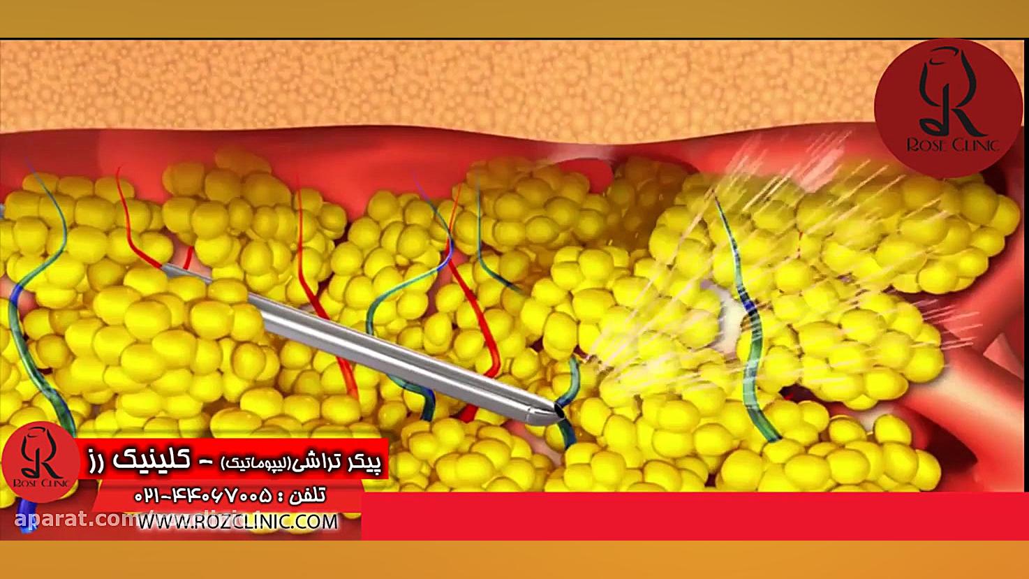 لیپوماتیک | فیلم لیپوماتیک | عمل لیپوماتیک | کلینیک پوست و مو رز | شماره 23 آزمایش بلوغ ریوی جنین