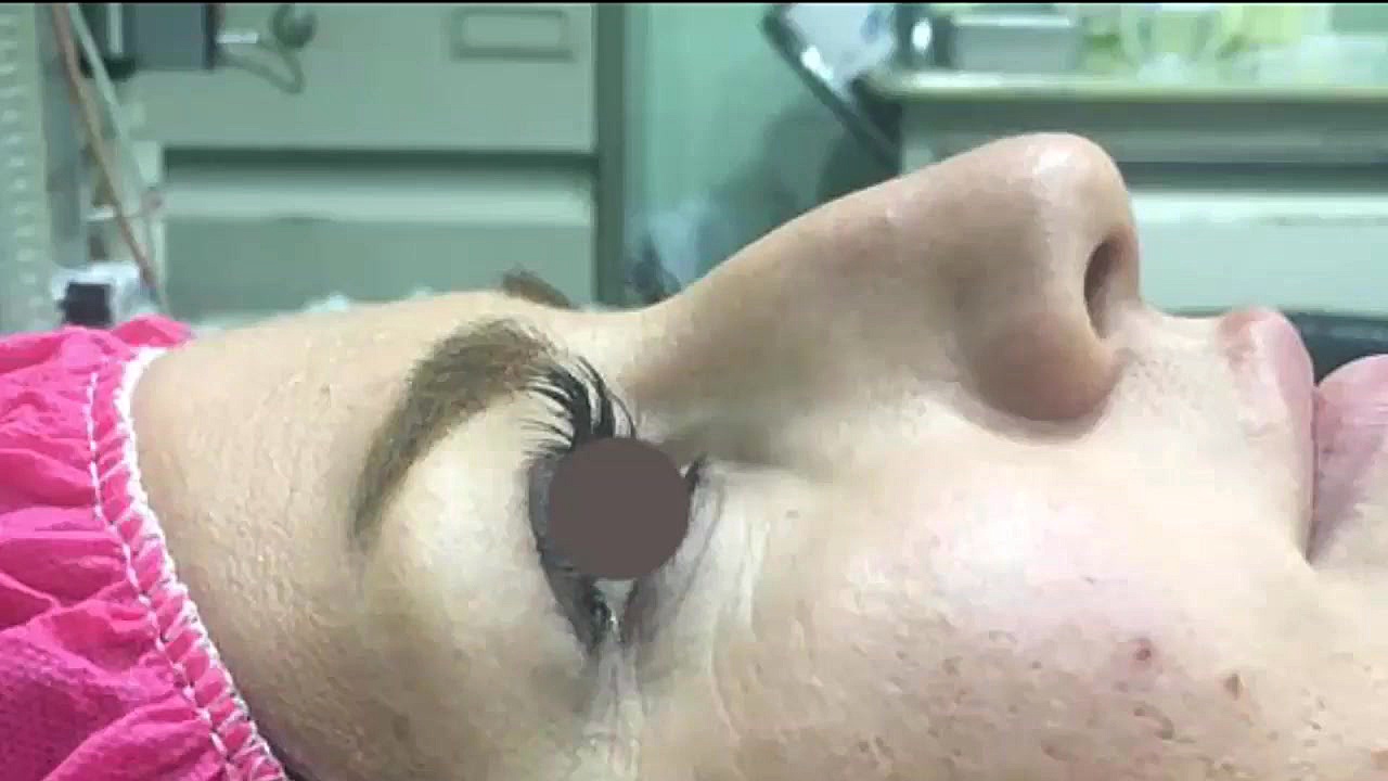 جراحی زیبایی بینی با فرم کاملا طبیعی جراحی بینی دکتر احمد توسلی اشرفی