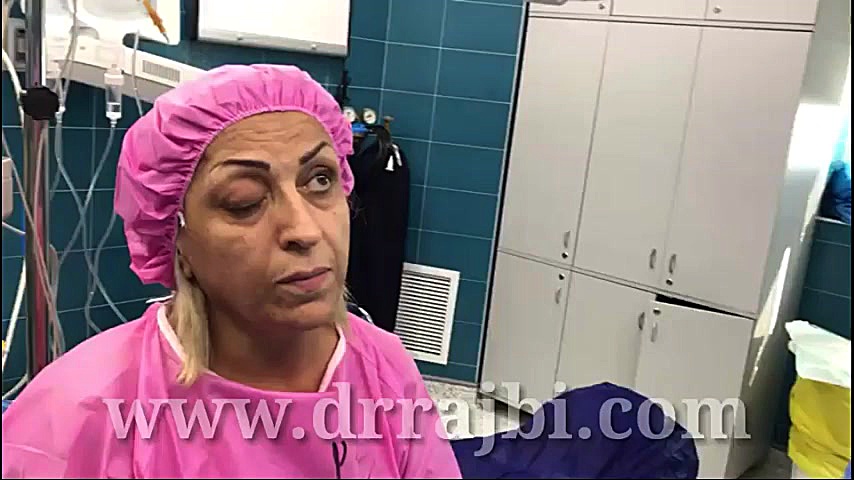 جراحی انحراف چشم در فلج عصب سوم لنز تماسی دارورسان