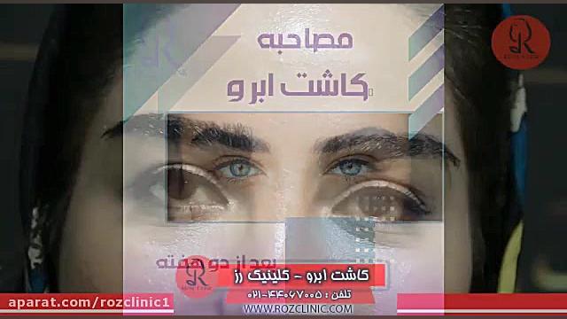 کاشت ابرو | فیلم کاشت ابرو | کلینیک پوست و مو رز | شماره 131 تزریق ژل