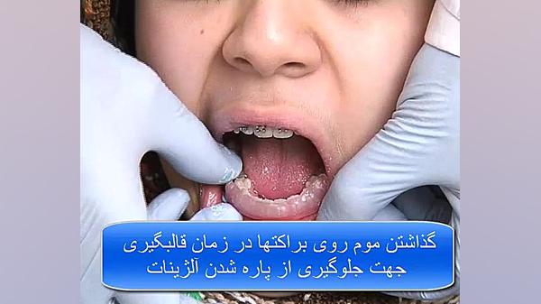 فیلم آموزشی نحوه ساخت نگهدارنده های ثابت برای بیماران ارتودنسی دستگاه فلوئورسنس تایم-لپس