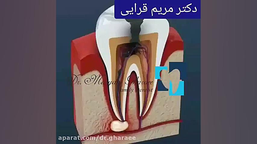 عصب کشی دندان چقدر طول می کشد؟ دکتر مریم قرایی