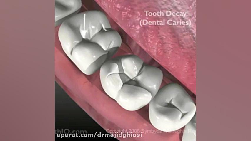 دلایل پوسیدگی دندان و راههای جلوگیری و مقابله با آن دکترمجیدقیاسی