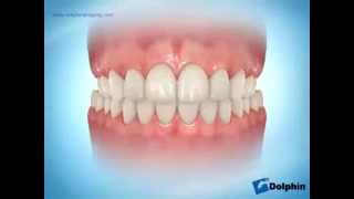 کراس بایت (cross bite) دکتر سهیل سالاری