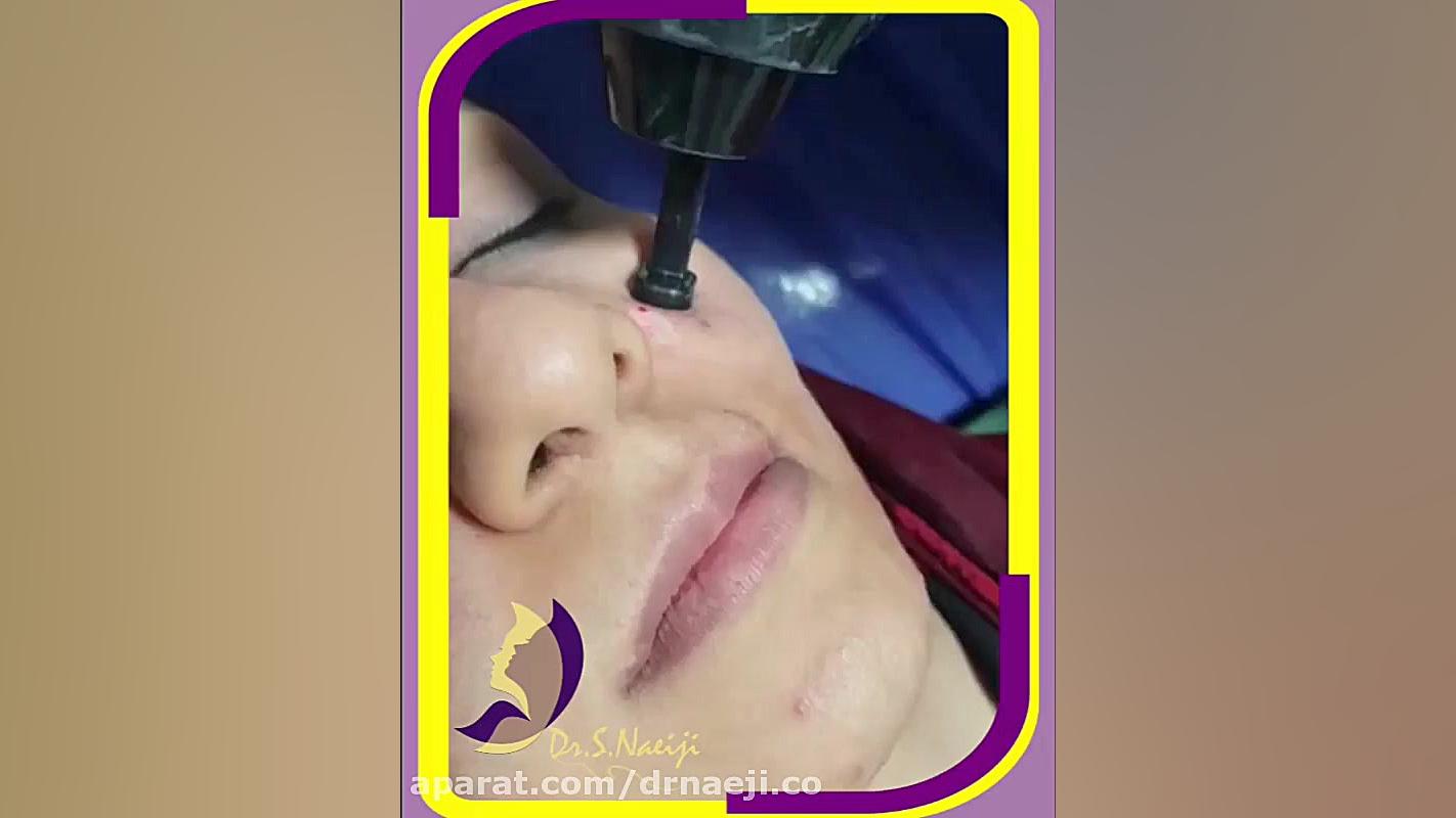 جوانسازی پوست صورت با لیزر فرکشنال دکتر صدیقه نائیجی | متخصص پوست و مو در قم