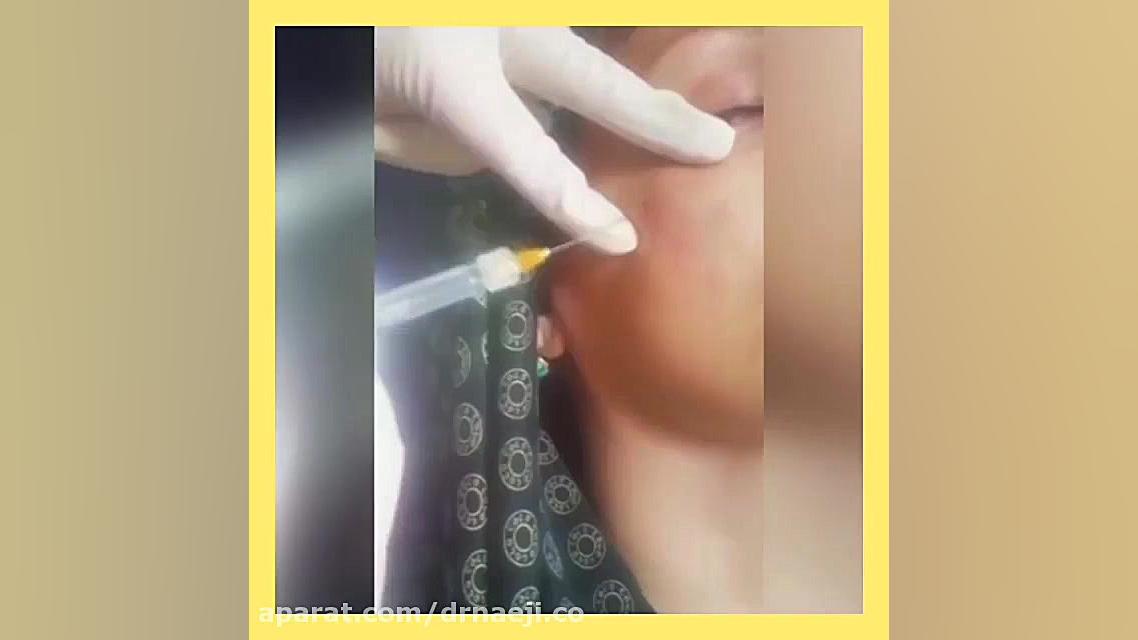 از بین بردن گودی زیر چشم با تزریق ژل دکتر صدیقه نائیجی | متخصص پوست و مو در قم