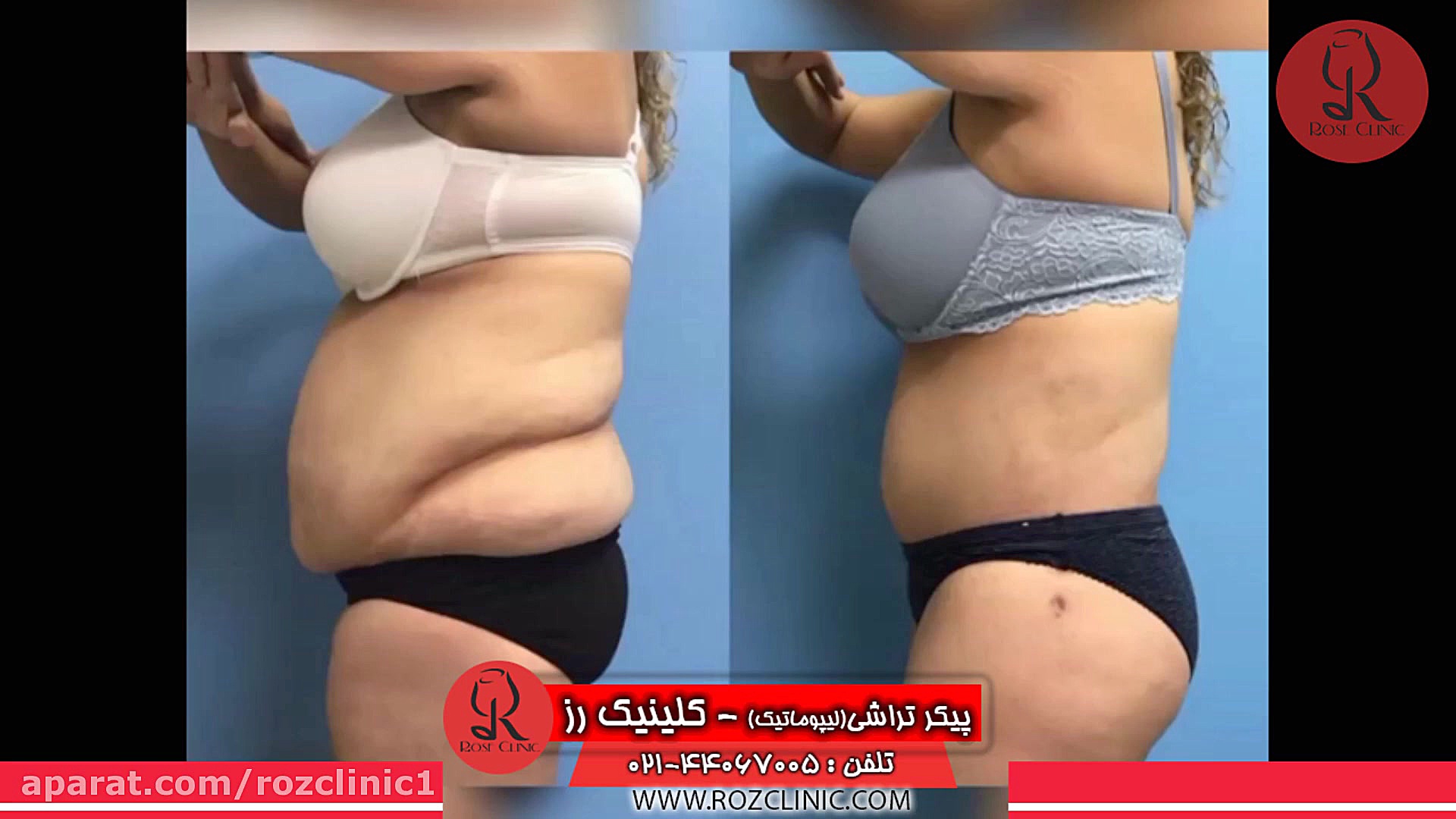 لیپوماتیک | فیلم لیپوماتیک | عمل لیپوماتیک | کلینیک پوست و مو رز | شماره 25 جراحی زیبایی پلک