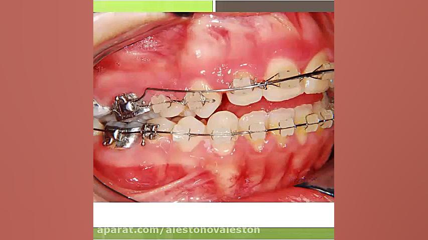 اصلاح باورنکردنی اپن بایت بدون جراحی فک و صورت NET-Seq