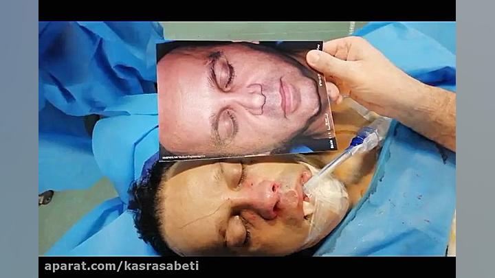 هشدار ویدیو دارای صحنه اتاق عمل است-عمل ترمیم بینی رفع افتادگی پلک