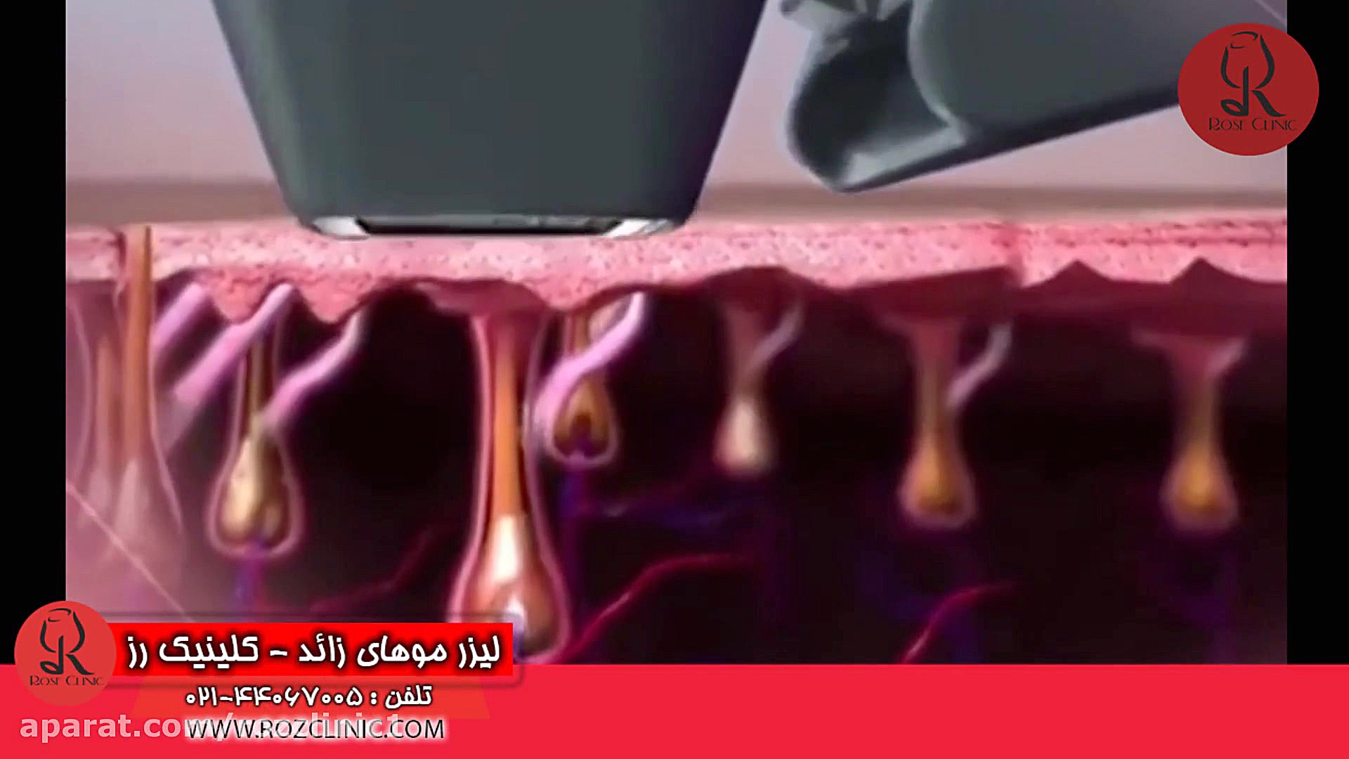 لیزر موهای زائد | لیزر مو | کلینیک پوست و مو رز | شماره 25 پلتفرم Drug Screening