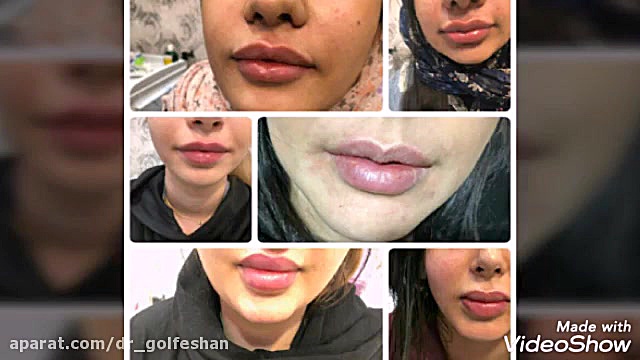 فیلر لب دکتر عاطفه گلفشان، متخصص پوست مو و لیزر درمانی