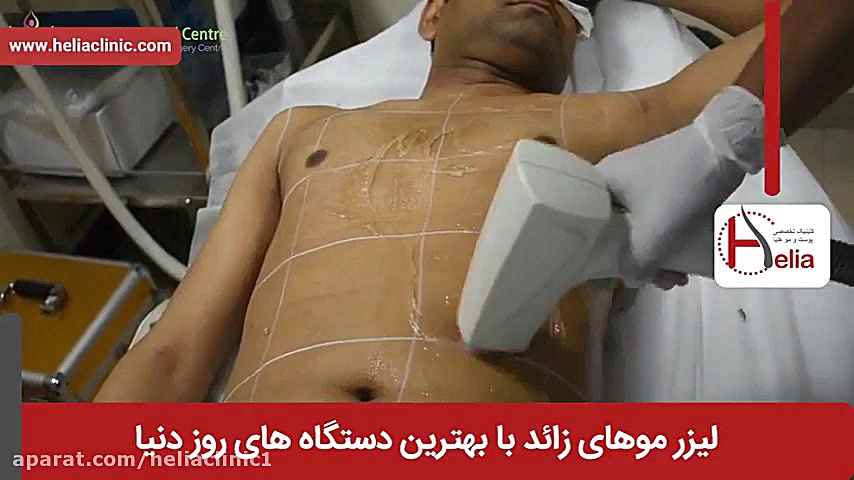 فیلم لیزر موهای زائد | کلینیک پوست و مو هلیا | شماره 30 | 02179547 کلونیک اسپاسم