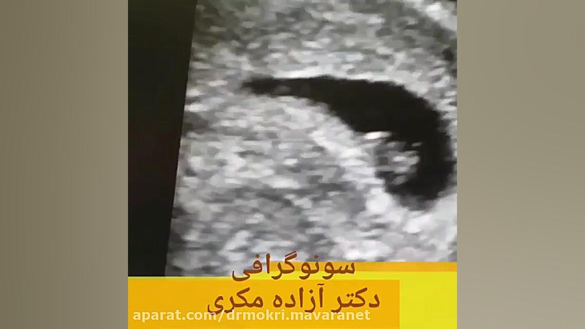 سونوگرافى جنين شش هفته و شش روز ادل