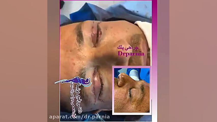 جراحی افتادگی پلک دکتر رفیع پرنیا فوق تخصص پلاستیک
