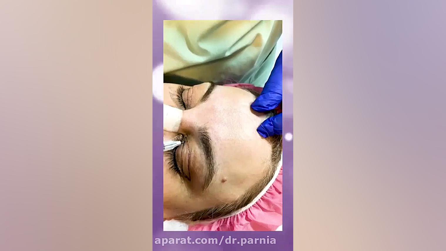 جراحی بلفاروپلاستی دکتر رفیع پرنیا فوق تخصص پلاستیک