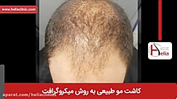فیلم کاشت مو | کلینیک پوست و مو هلیا | شماره 32 | 02179547