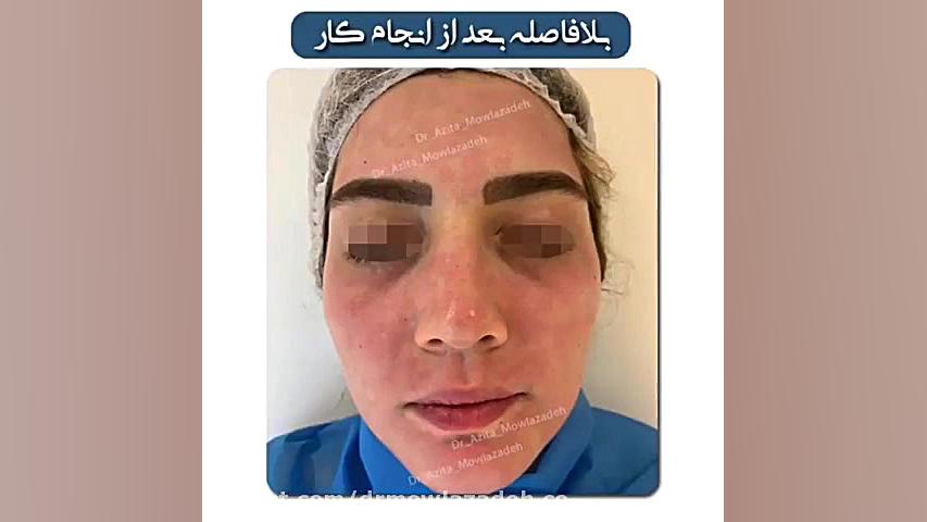 جوانسازی پوست با لیزر RF فرکشنال | دکتر آزیتا مولازاده آزمون NanoString