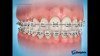 تغییر رنگ دندانها به دنبال عدم رعایت بهداشت در ارتودنسی دکتر سهیل سالاری