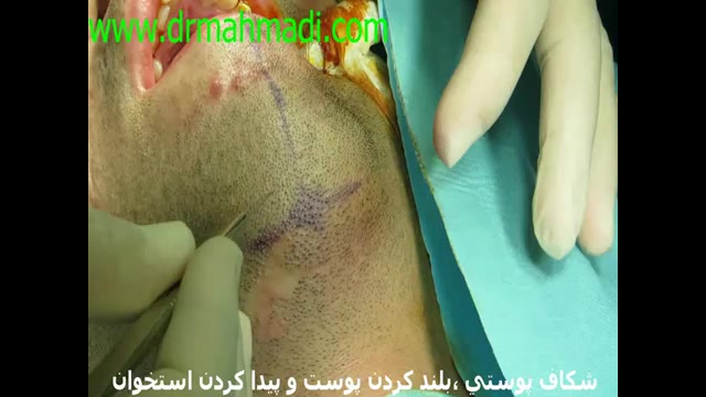فیلم عمل جراحی پروتز چانه بهترین جراح زیبایی دکتر مهدی احمدی