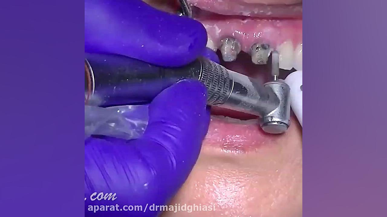 مراحل حذف ونیر قدیمی دندان و جایگزینی با ایمپلنت دکترمجیدقیاسی