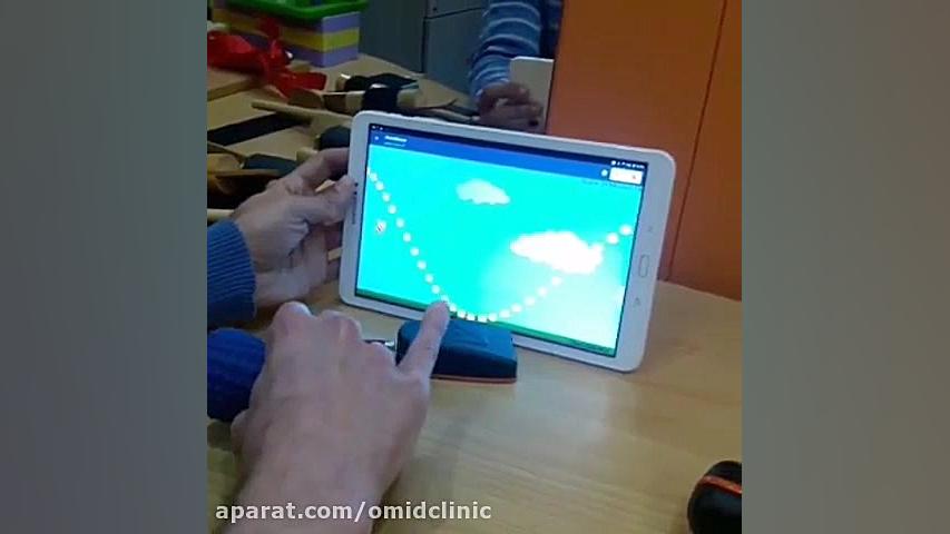 بیمار با اختلال دیستونی دماغ آلبالویی