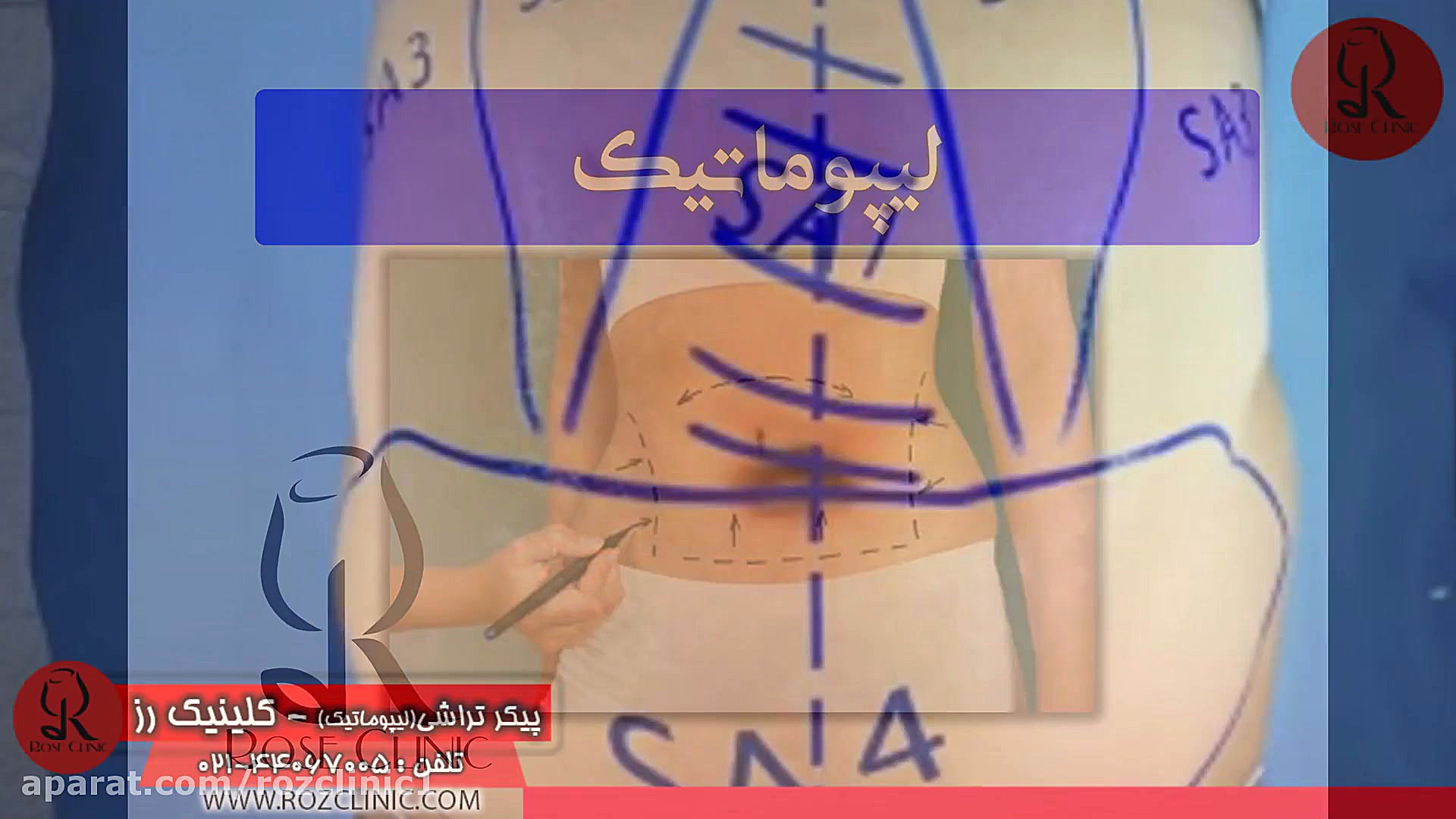لیپوماتیک | فیلم لیپوماتیک | عمل لیپوماتیک | کلینیک پوست و مو رز | شماره 29 بیولوژی پرتوی