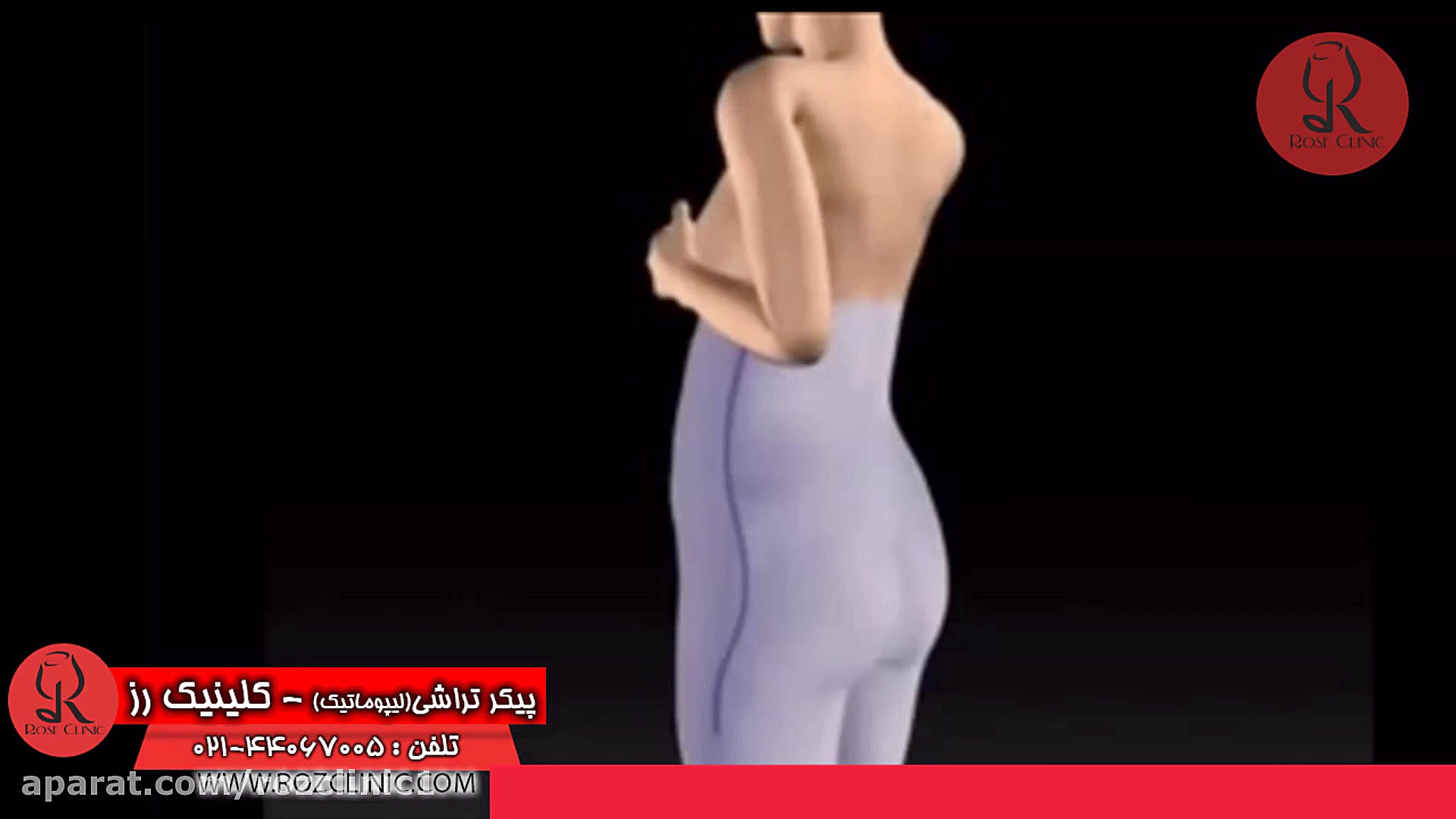 لیپوماتیک | فیلم لیپوماتیک | عمل لیپوماتیک | کلینیک پوست و مو رز | شماره 30 برداشتن خال گوشتی