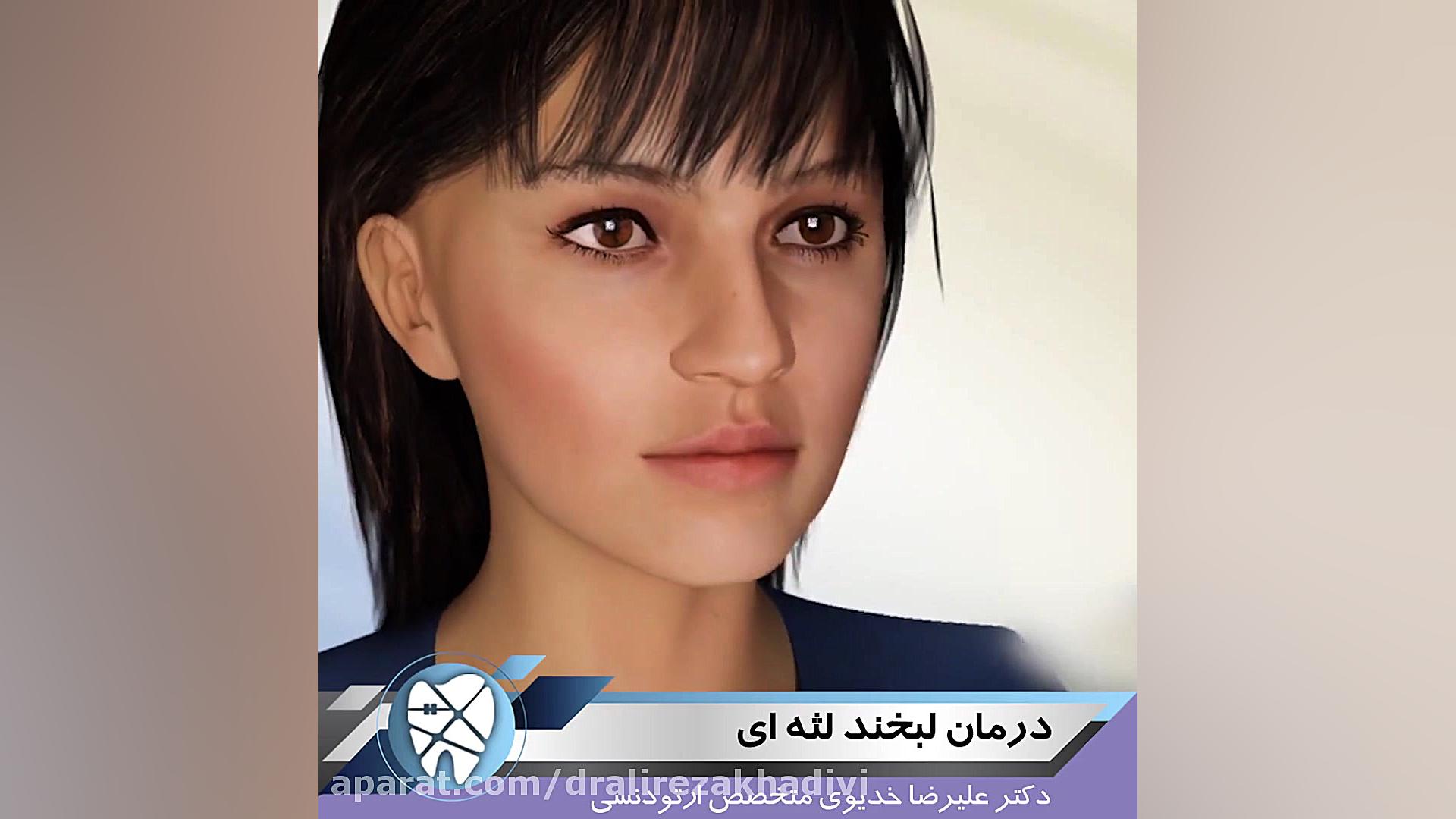 درمان لبخند لثه ای دکتر علیرضا خدیوی