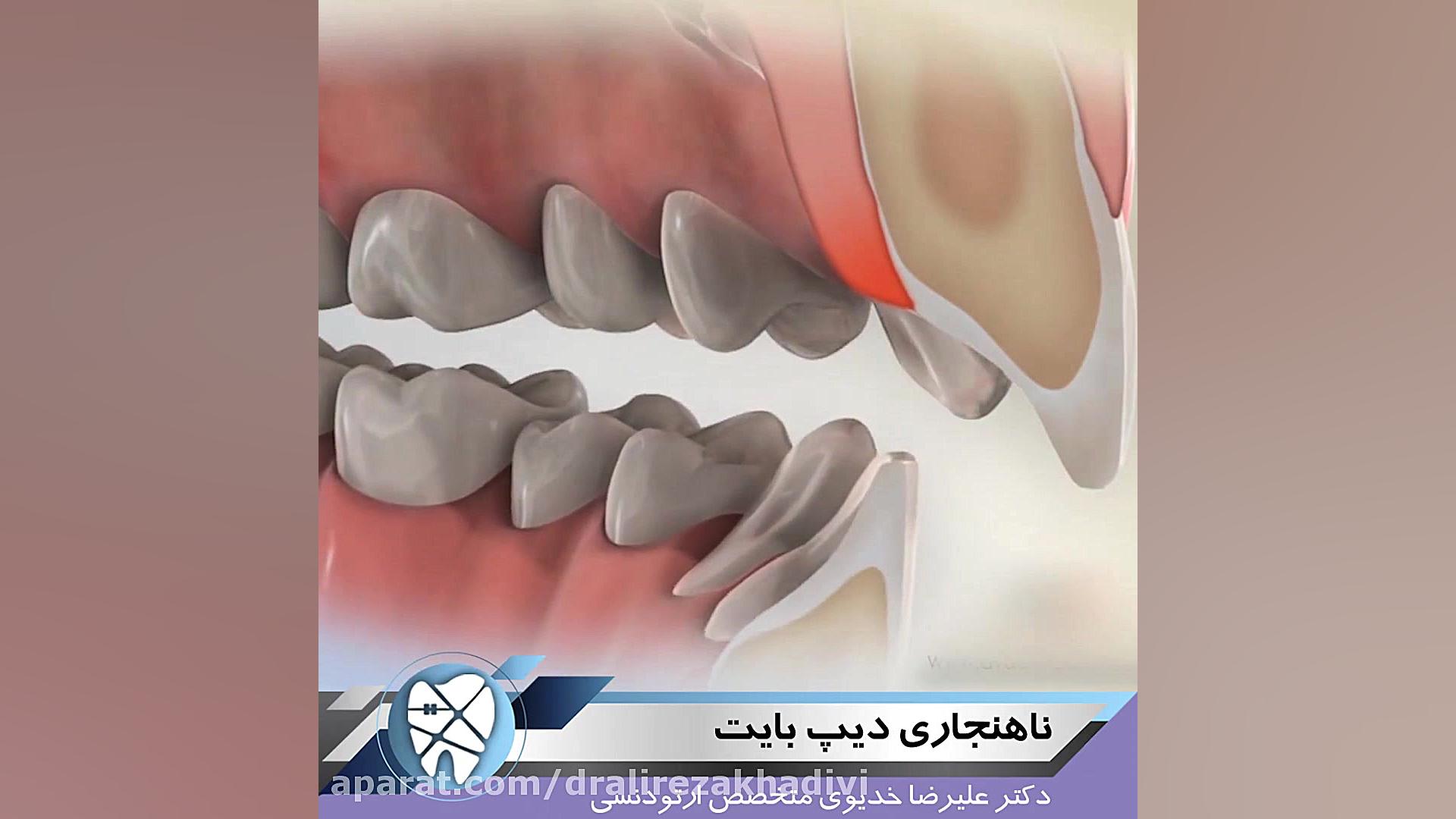 ناهنجاری دیپ بایت دکتر علیرضا خدیوی