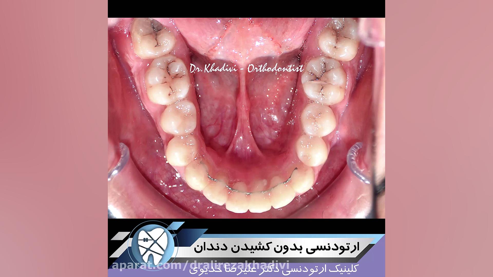 ارتودنسی بدون کشیدن دندان دکتر علیرضا خدیوی