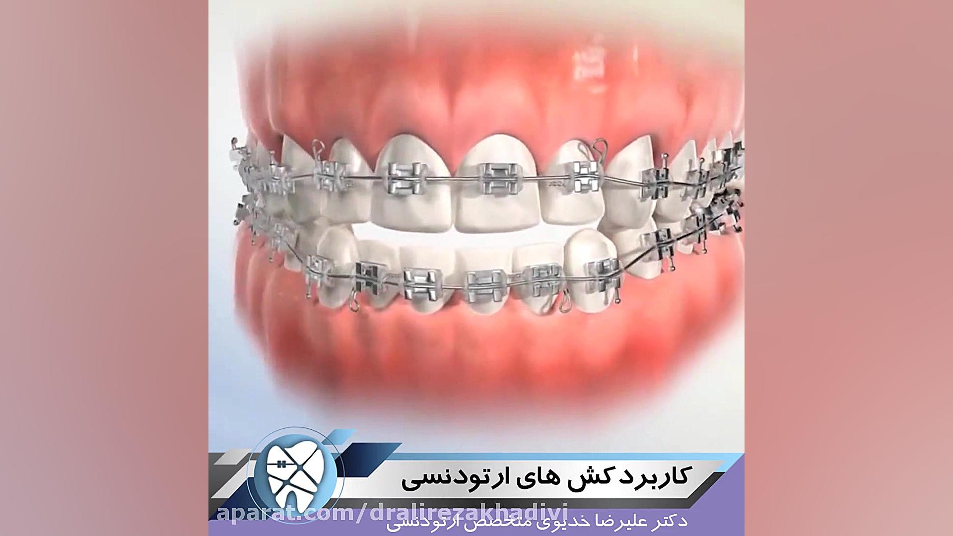 کاربرد کش های ارتودنسی دکتر علیرضا خدیوی