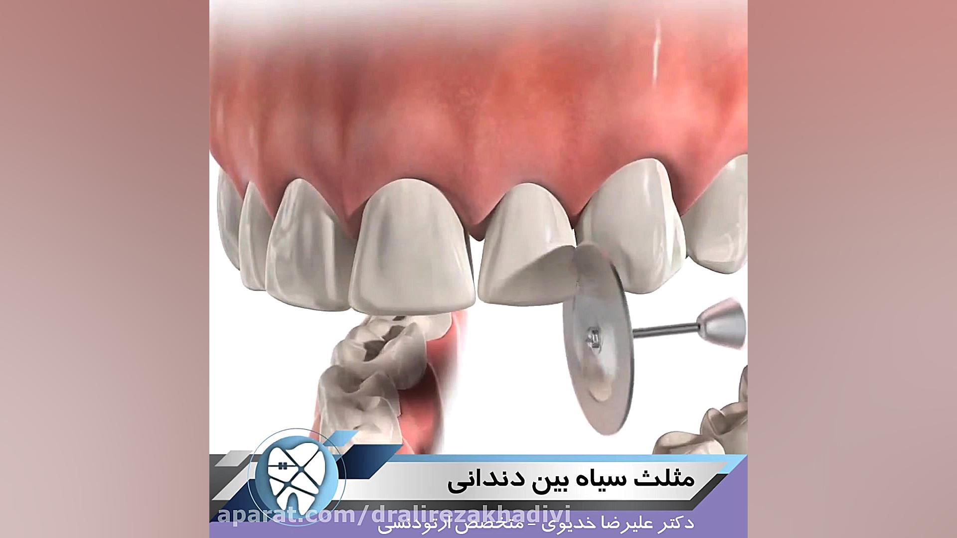 مثلث سیاه بین دندانی دکتر علیرضا خدیوی