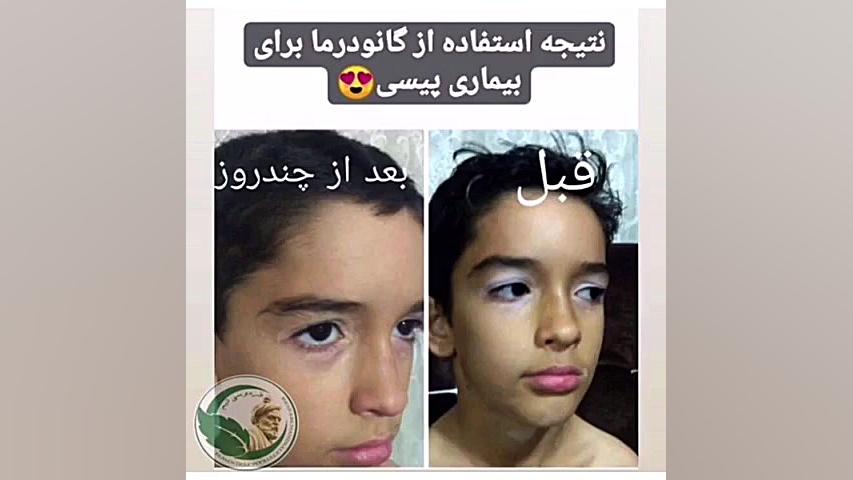 خبر خوش برای کسانی که مبتلا به پیسی برص و ویتیلیگو هستند تزریق بوتاکس