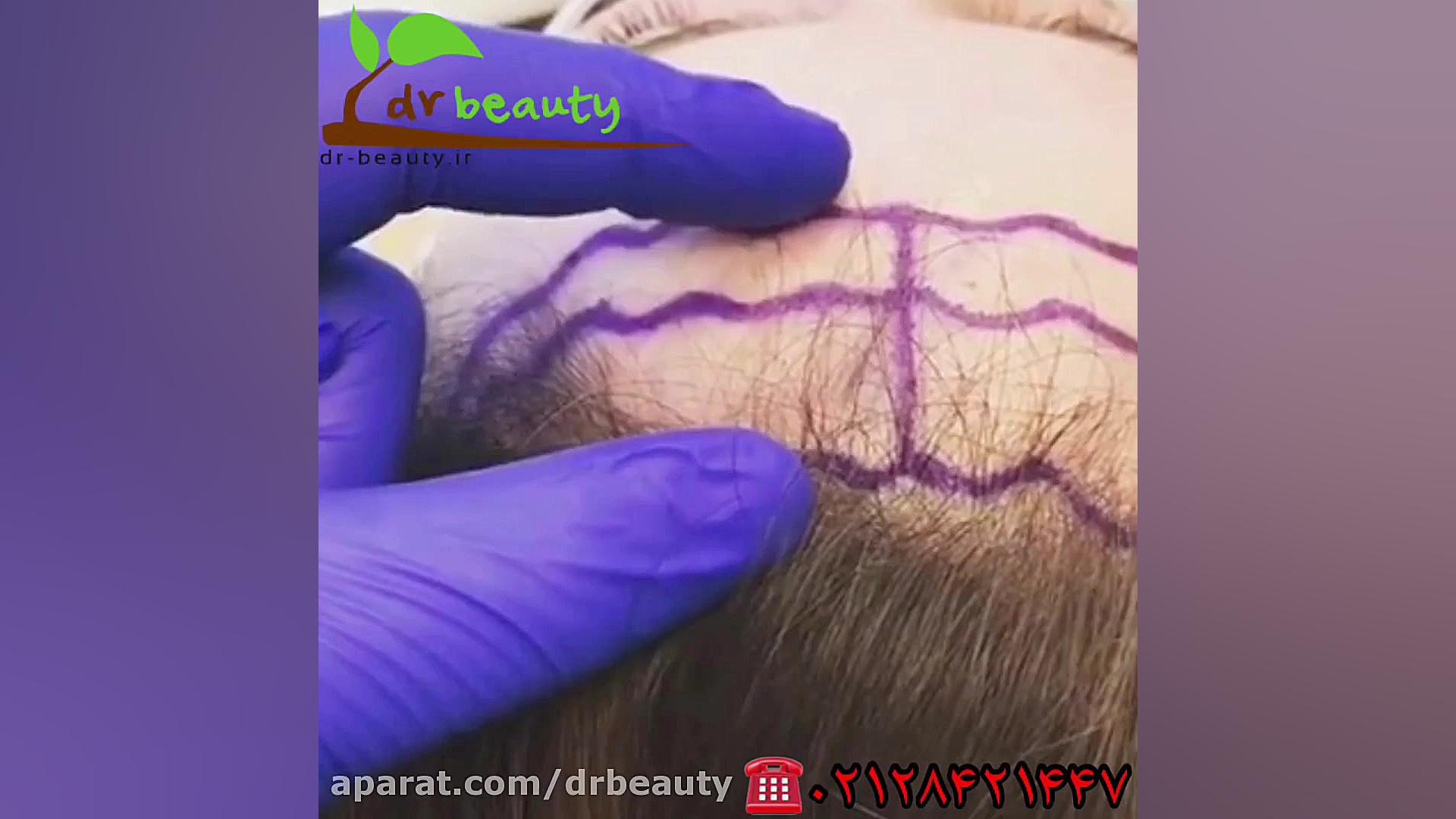 کوتاه کردن پیشانی بلیچینگ