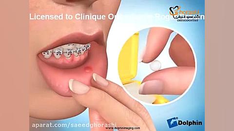 موم در ارتودنسي دکتر سعید قریشی