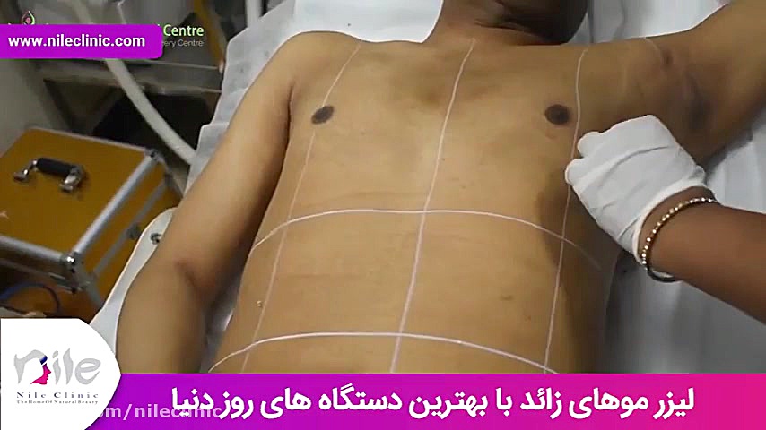 لیزر موهای زائد | فیلم لیزر موهای زائد | کلینیک پوست و مو نیل | شماره 20 پالپوتومی