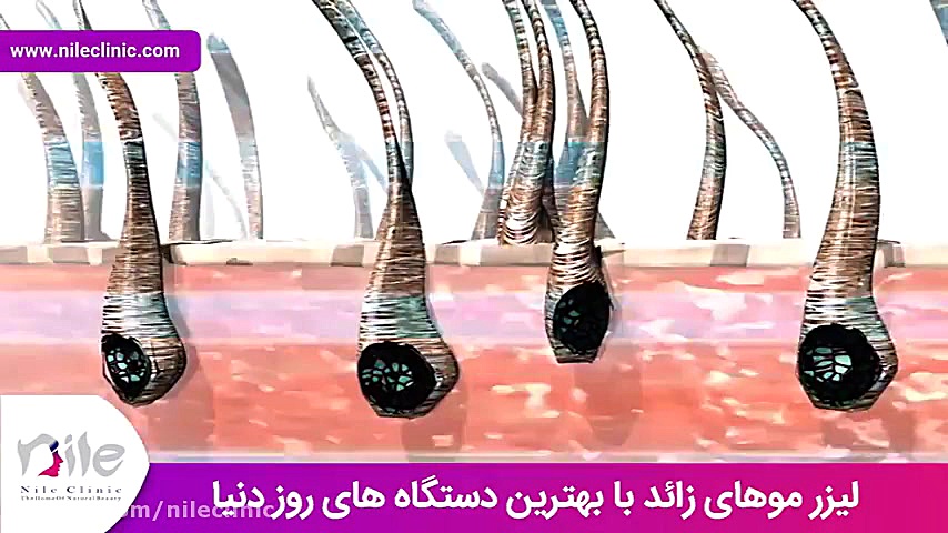 لیزر موهای زائد | فیلم لیزر موهای زائد | کلینیک پوست و مو نیل | شماره 21 لیزر مو