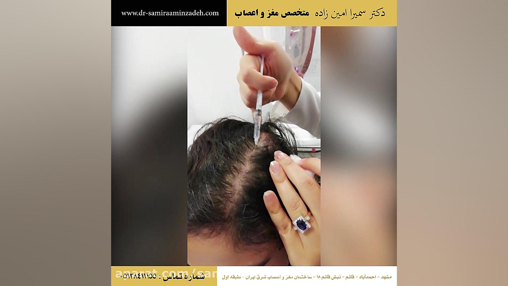 تکنیک مزوتراپی و درمان ریزش مو و تقویت ساقه مو در مشهد سنداکتیلی
