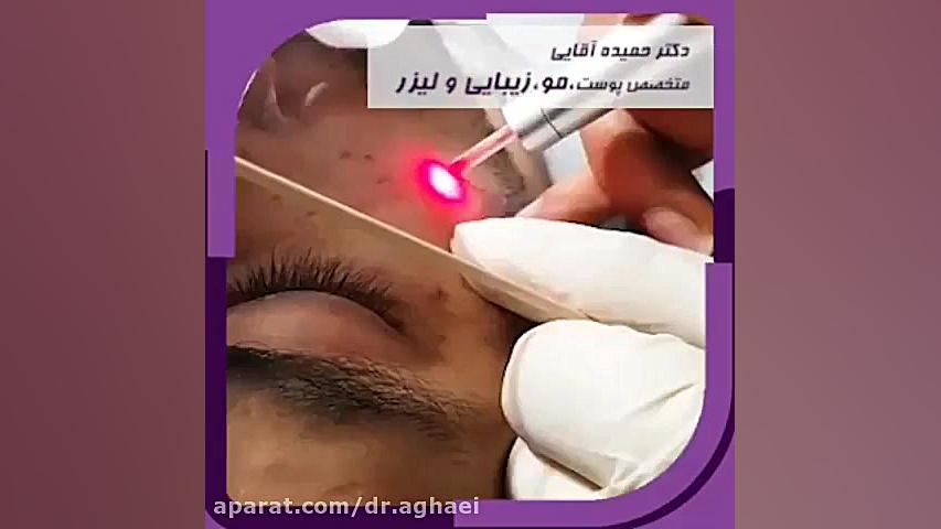 فیلم برداشتنن خال با لیزر دکتر حمیده آقایی متخصص پوست و مو دکتر حمیده آقایی