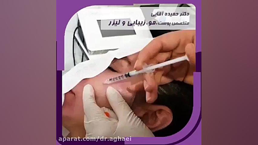 جوانسازی پوست با مزوتراپی صورت بیومهندسی عصبی