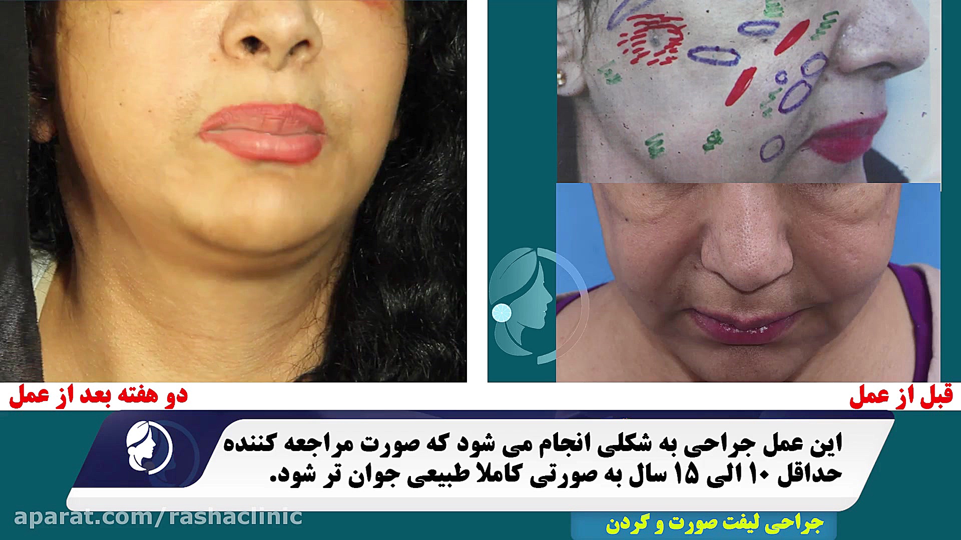 نتیجه فوق العاده تخلیه ژل پاژ به همراه لیفت صورت پالبوسیکلیب