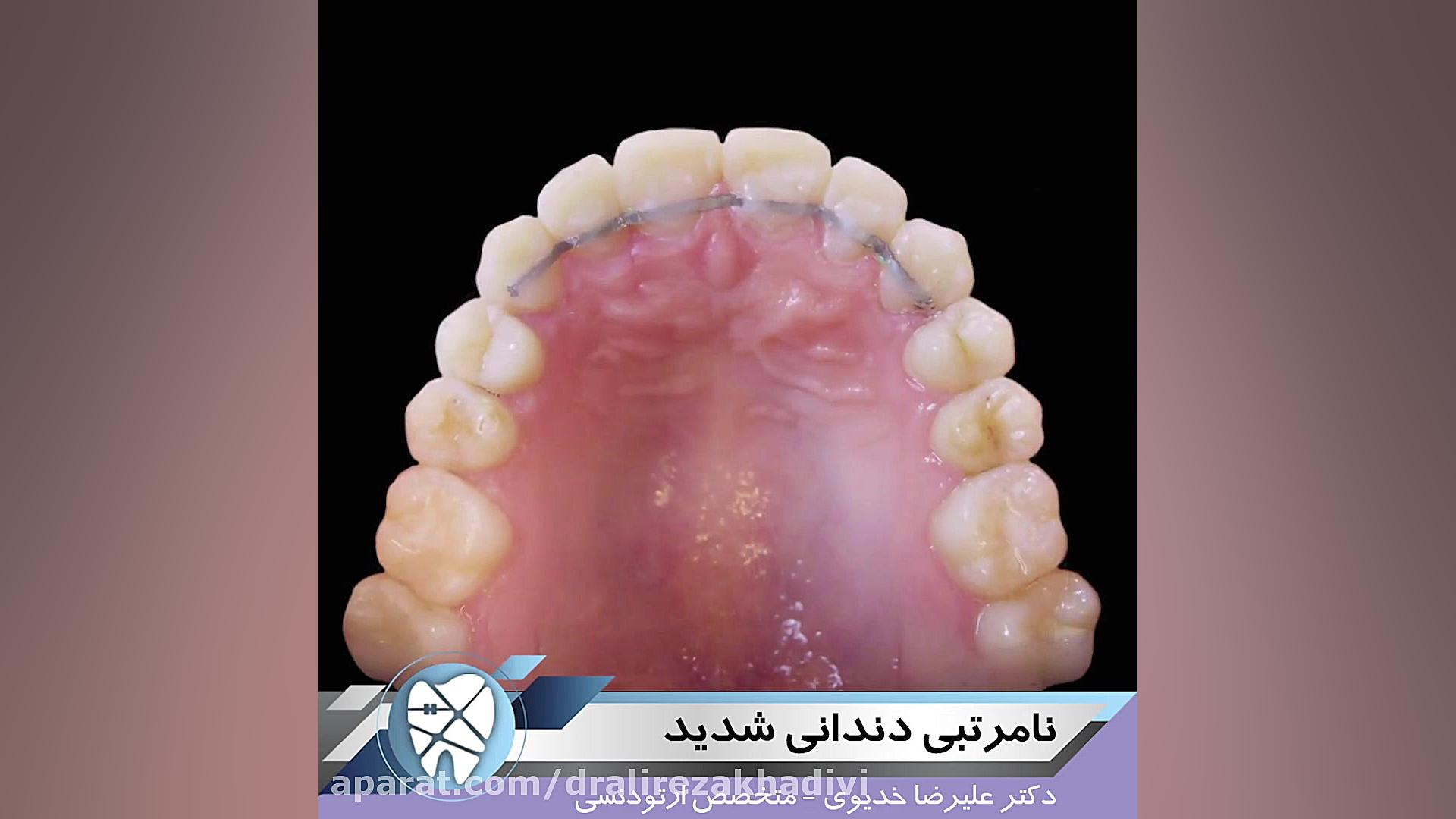 نامرتبی دندانی شدید دکتر علیرضا خدیوی