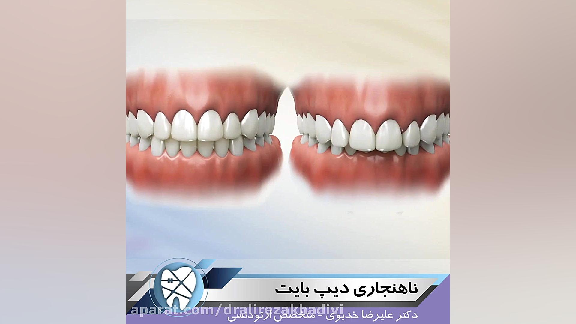 ناهنجاری دیپ بایت دکتر علیرضا خدیوی