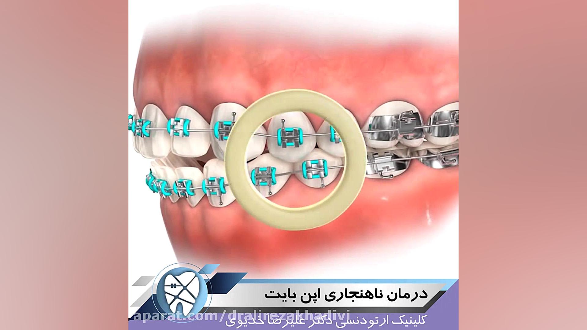 درمان ناهنجاری اپن بایت دکتر علیرضا خدیوی