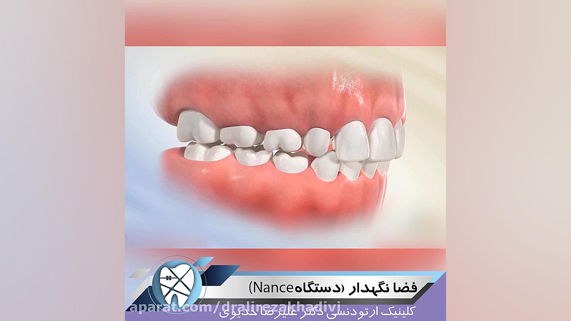 فضا نگهدار (دستگاهNance) دکتر علیرضا خدیوی