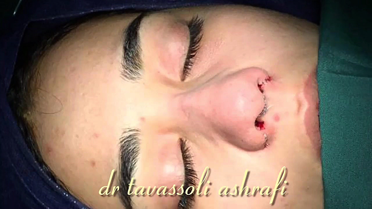 جراحی زیبایی بینی (به روش باز) با فرم کاملا طبیعی جراحی بینی دکتر احمد توسلی اشرفی