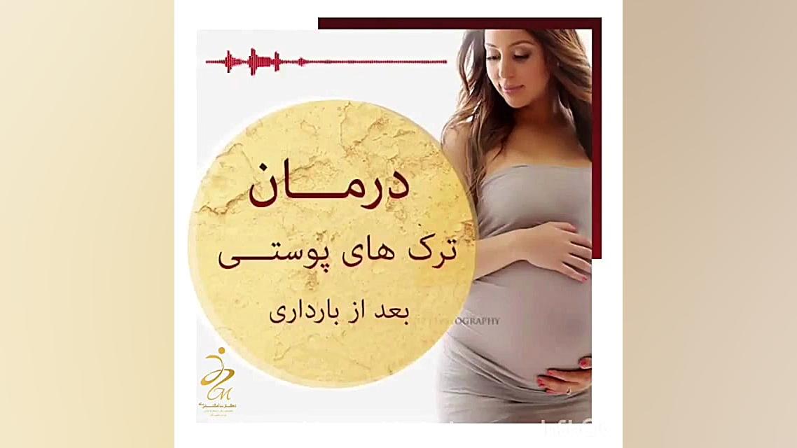 درمان ترک های پوستی بعد از بارداری و زایمان پریودنتیکس