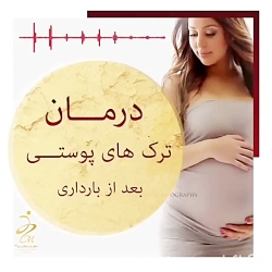 درمان ترک های پوستی بعد از بار...